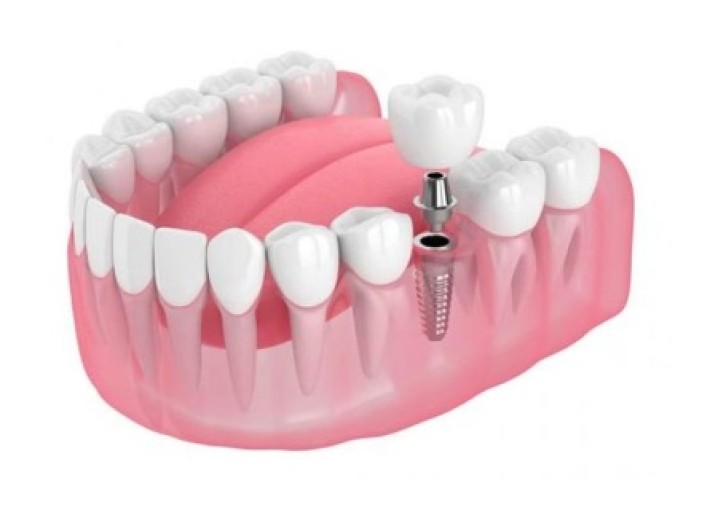 Как сделать имплантацию всех зубов