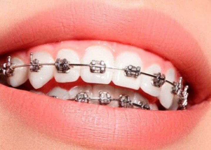 Ортодонтия и ее преимущества