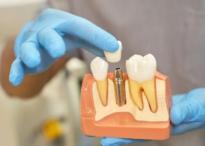 Имплантация зубов: преимущества процедуры
